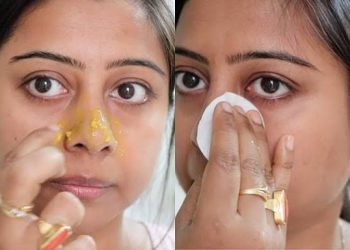முகத்தில் தோன்றும் கரும்புள்ளிகளிற்கு இயற்கையான தீர்வு