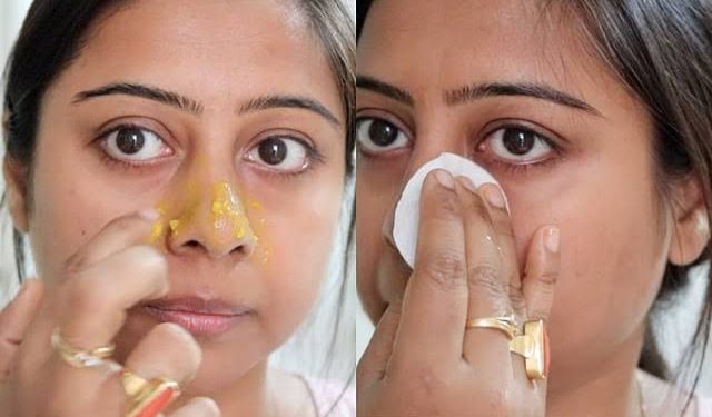 முகத்தில் தோன்றும் கரும்புள்ளிகளிற்கு இயற்கையான தீர்வு